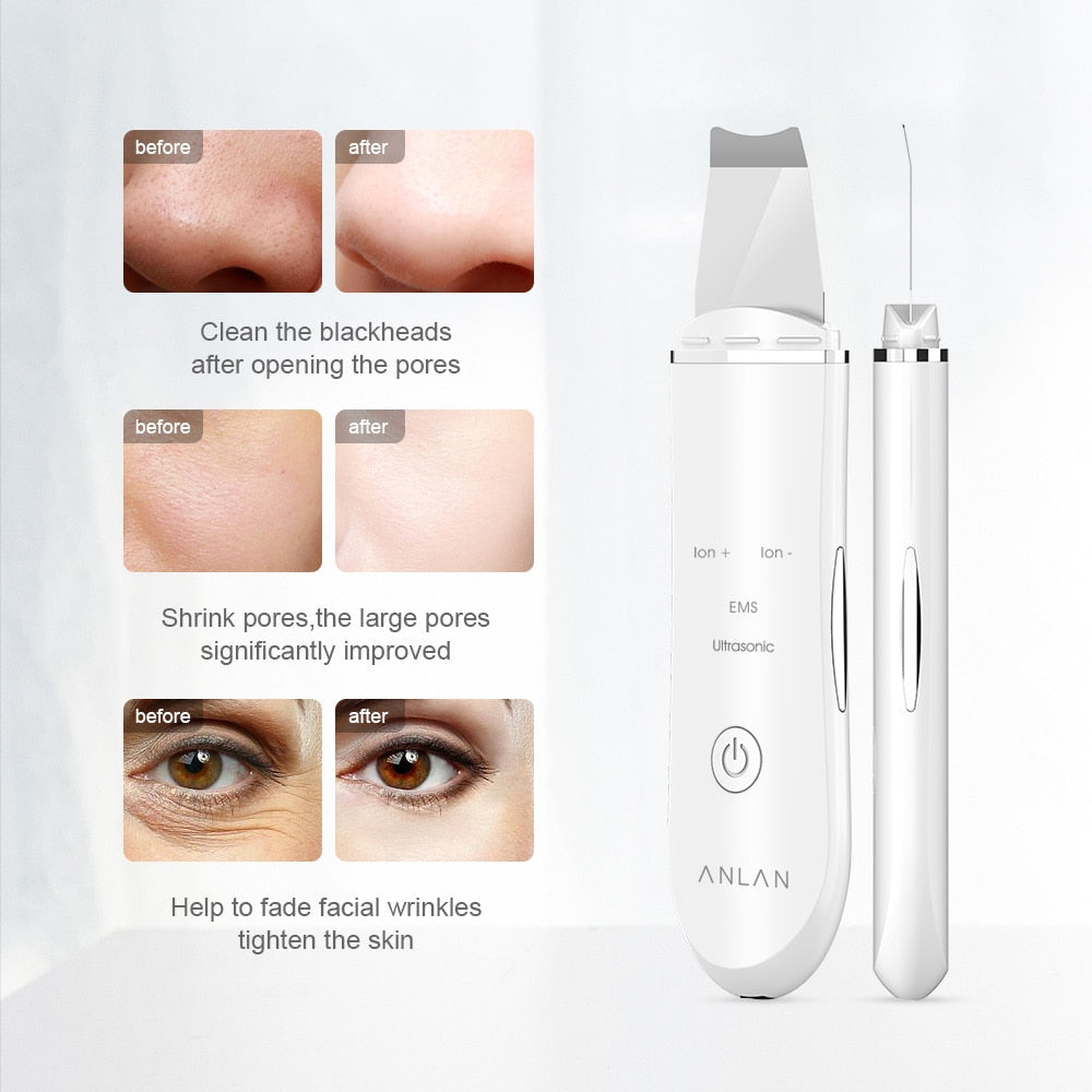Ultrasonic Skin Lift Machine - Bazaare Mart