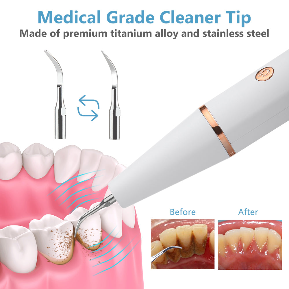 Ultrasonic Tooth Calculus Remover - Bazaare Mart